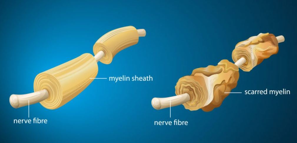 Multiple sclerosis 